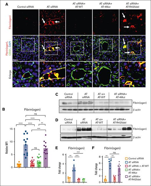 Characterization of the prothrombotic phenotype of AT-deficient and AT-infused mice. Mice were treated with control siRNA or AT siRNA followed by infusion of saline, AT-WT, AT-4Mut, or AT-R425del at 24 and 48 hours of siRNA treatment as shown in Figure 1. Mice were euthanized after 72 hours of siRNA treatment and perfused with PBS. (A) Perfused liver cryosections were fixed, permeabilized, and incubated with anti-fibrin(ogen) (rabbit) and anti-CD31 (goat) antibodies followed by Alexa Fluor 555–conjugated anti-rabbit and Alexa Fluor 488–conjugated anti-goat antibodies. DAPI (4′,6-diamidino-2-phenylindole) was used to stain the nucleus. The arrows indicate intravascular thrombosis. Inset boxes from each group are magnified. Scale bar, 50 μm. (B) Relative mean fluorescence intensity (MFI) of fibrinogen stain in (panel A) is presented. (C-D) The perfused left lobe of the liver was collected in the tissue lysis buffer and immunoblotted for fibrin(ogen). β-actin was used as a loading control. (E-F) Densitometric analysis of fibrin(ogen) deposition in the liver tissue sample is presented. All data are presented as mean ± SEM. n ≥ 3. Statistical analysis was performed using Graph Pad Prism 10. P values are determined by 1-way ANOVA, followed by Bonferroni multiple comparison test. ∗P < .05; ∗∗P < .01; ∗∗∗P ≤ .001; ∗∗∗∗P ≤ .0001. MFI, mean fluorescence density; ns, not significant.