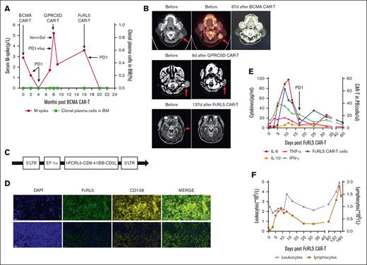 Treatment course of patients receiving BCMA-, GPRC5D-, and FcRL5-targeted CAR-T therapies. (A) Serum M-spike and clonal plasmas in the BM aspirate. (B) Top, positron emission tomography–computed tomography (CT; left) scan of the extramedullary soft mass in the left neck and head CT scan (right) during BCMA CAR-T infusion; middle, head CT scan of the extramedullary soft mass behind the left ear before and after GPRC5D CAR-T infusion; and bottom, cranial magnetic resonance imaging of the extramedullary soft mass in the left temporal region before and after FcRL5 CAR-T infusion. (C) The schematic of structure of FcRL5 CAR. (D) Immunofluorescence indicating the expression of FcRL5 in extramedullary myeloma cells. The lower panel as control and CD138 as positive control; scale bar, 50 μm. (E) Serum cytokines and CAR-T numbers in PB during FcRL5 CAR-T infusion. (F) The cell numbers of leukocyte and lymphocyte in PB during FcRL5 CAR-T infusion. BM, bone marrow; DAPI, 4′,6-diamidino-2-phenylindoleIFN-γ, interferon gamma; IL-6, interleukin-6; Ixa, ixazomib; LTR, long terminal repeats; PB, peripheral blood; PD1, anti-PD1 antibody; Sel, selinexor; TNF-α, tumor necrosis factor- α; Ven, venetoclax.