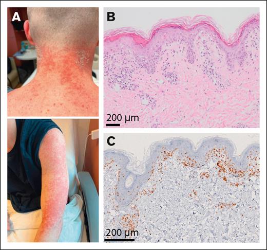aGVHD in an ICI-treated patient with mixed chimera. (A) Photographs of an ICI-treated patient with mixed chimera after alloBMT who developed erythematous maculopapular skin lesions. (B) Skin sampling revealed lymphocytic exocytosis and scattered intraepidermal dyskeratotic cells, overlying a scant dermal perivascular inflammatory infiltrate composed of lymphocytes and histiocytes with vacuolar interface dermatitis including vacuolar changes of basal keratinocytes. (C) Immunohistochemistry using an anti-CD3 antibody showed T-cell infiltrate involving the epidermis and superficial dermis.