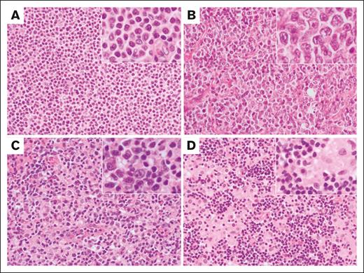 Variation in morphological findings in PTCL-NOS. Histological features for PTCL-NOS include the following patterns: (A) monomorphic small-intermediate size cells with abundant cytoplasm, (B) monomorphic sheets of large cells, (C) neoplastic cells interspersed within a mixed inflammatory background, or (D) a lymphohistiocytic morphology characterized by small neoplastic cells within clusters of epithelioid histiocytes (termed Lennert pattern). Original magnification x200 and inset magnification x400. Adapted from Amador et al.32