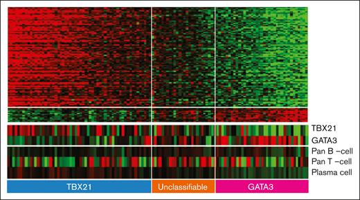 Heat map from gene profiling studies depicting the two major molecular subgroups within PTCL-NOS in adults. Unique gene expression signatures identify the TBX21 and GATA3 subgroups of PTCL-NOS, which are associated with prognostic significance in adults, with worse survival associated with the GATA3 subgroup. A third, unclassifiable subgroup is also identified, highlighting the overall biological heterogeneity that characterizes PTCL-NOS. Adapted from Iqbal et al.39