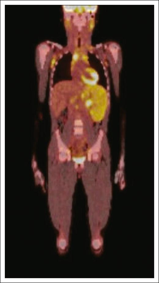 Radiographic depiction of clinical presentation of PTCL-NOS. Positron emission tomography scan reveals diffuse nodal and extranodal disease including involvement of axillary and inguinal nodes, parotid glands, anterior mediastinal mass, and spleen, as well as suggestion of bone marrow involvement in a pediatric patient with PTCL-NOS at initial presentation.