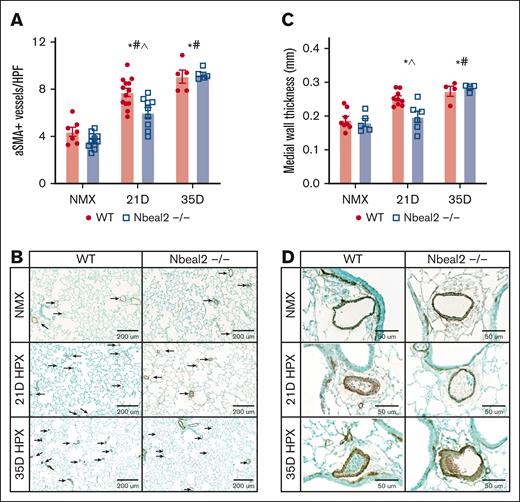 Hypoxia-induced PVR was delayed in Nbeal2−/− mice compared with WT mice. Whole-slide scans were obtained using the Leica Aperio VERSA brightfield scope (×40 objective, 0.5-micron resolution). (A) At day 21, hypoxia-induced muscularization of vessels of <50 μm was attenuated in Nbeal2−/− compared with WT mice. At day 35, hypoxia-induced muscularization of vessels of <50 μm was similar between WT and Nbeal2−/− mice. (B) Representative α-SMA staining in the distal lung (original magnification ×10; scale bars, 200 μm). (C) At day 21, the hypoxia-induced increase in MWT was prevented in Nbeal2−/− mice. At day 35, the hypoxia-induced increase in MWT was similar between WT and Nbeal2−/− mice. (D) Representative vessel images (original magnification ×40; scale bars, 50 μm). Statistics: P ≤.05 by 2-way ANOVA with Tukey post hoc analysis. Comparisons: (∗) WT compared with WT baseline, (#) Nbeal2−/− compared with Nbeal2−/− baseline, (^) WT compared with Nbeal2−/−. HPF, high-powered field; HPX, hypoxia; NMX, normoxia.