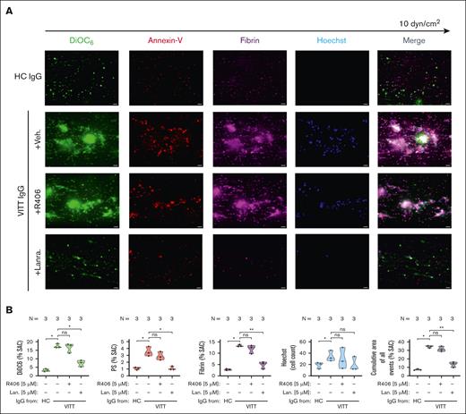 VITT Ab–induced procoagulant PLT-mediated thrombus formation can be prevented via the inhibition of SYK in PLTs. (A-B) PLTs from healthy individuals were incubated with IgG from patients with VITT in the presence of exogenous PF4 (10 μg/mL) and indicated SYK inhibitors or vehicle control (upper panel) before reconstitution into autologous PLT-depleted WB and perfusion through microfluidic channels at a venous shear rate of 250 sec–1 (10 dyne) for 25 minutes. (A) After perfusion, images were acquired at magnification ×40. Scale bar, 20 μm. (B) Violin plots showing the percentage of total (% SAC) by DiOC6, PS, fibrin(ogen), count of Hoechst-positive–labeled cells; and cumulative total % SAC of DiOC6, PS, and fibrin(ogen)-labeled thrombus captured in the microfluidic channel. Unpaired or paired t test is shown. ∗P < .05; ∗∗P < .01; ∗∗∗P < .001. N, number of patients tested; ns, nonsignificant.