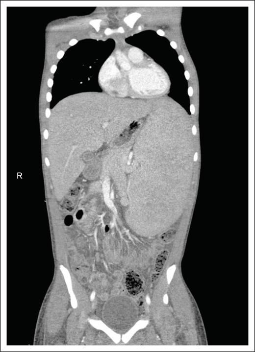 Imaging findings in HSTCL. CT scans of the abdomen and pelvis typically reveal massive hepatosplenomegaly, displacing other organs, with minimal enlarged lymph nodes. R, right side of the body.