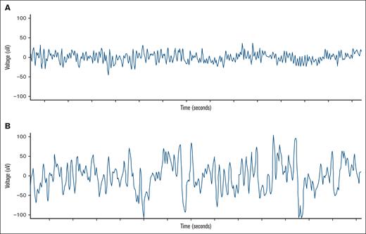 Example of a single-channel EEG. A normal EEG after infusion of CAR T cells (A), and an EEG 24 hours prior to ICANS (B).