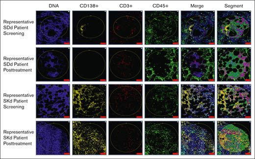 Representative ROI selection and segmentation process. Using fluorescently labeled morphology probes, ROIs were selected to capture target cells while avoiding areas of histologic and staining artifacts. Segments containing specific cell types were hierarchically defined and are shown in the last column as: orange (CD138+ plasma cells), teal (CD3+ T cells), pink (CD45+ cells other than CD138+ plasma cells and CD3+ T cells), and green (all other cells not previously selected) zones. The top 2 rows show representative ROIs from pretreatment and posttreatment biopsy samples of a patient from arm 5 (SDd). The pretreatment sample shows plasma cell aggregates, whereas the posttreatment sample, taken during response, did not have any evidence of residual myeloma. The bottom 2 rows show representative ROIs from pretreatment and posttreatment biopsy samples of a patient from arm 6 (SKd). Unlike most patients who showed rare to no plasma cell involvement at the end of treatment, this patient showed persistently high disease burden with sheets of plasma cells at both time points. Scale bar, 100 μm.