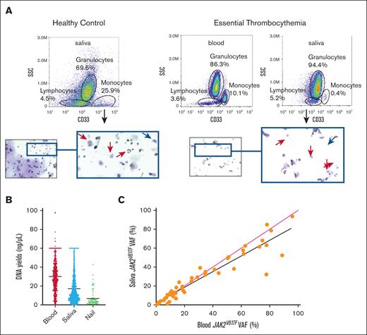 Saliva’s abundant leukocytes allow it to be an adequate noninvasive alternative to blood for genetic material. (A) Flow cytometry (top) and cytospin histology (bottom) of saliva from a healthy control and patient with essential thrombocythemia. Red arrows indicate leukocytes, and blue arrows indicate buccal epithelium. (B) Distribution of the genomic DNA concentrations isolated from blood (n = 570), saliva (n = 1670), and nails (n = 72); blood and saliva were eluted in 100 μL, and nails were eluted in 50 μL. Input amount of blood, saliva, and nails was 400 μL, 400 μL, and 20 mg respectively. (C) Concurrent blood and saliva samples were obtained from 49 patients with MPN, and JAK2V617F allele burden was measured by dPCR (r2 = 0.8931; P < .0001). Line of best fit, black; line of actual VAF, red.