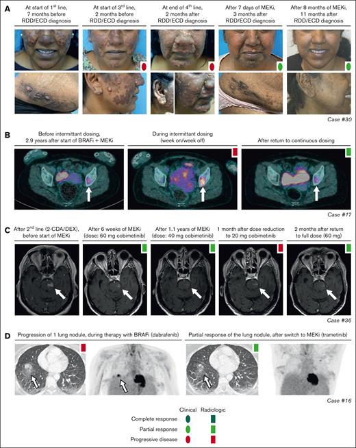 Response and rare disease progression on targeted therapy. (A) Photographs showing response of skin lesions in case 30 with RDD/ECD to conventional therapies and targeted treatment with cobimetinib. (B) Axial PET-computed tomography (CT) images of case 17 with ECD showing increased fluorodeoxyglucose (FDG) uptake of a left acetabular lesion (indicated by a white arrow) during intermittent dosing of dabrafenib/trametinib. After returning to continuous therapy, PET-CT showed decreased FDG uptake in the acetabular lesion, consistent with a recaptured PR. (C) Axial T1-weighted gadolinium-enhanced MRI images of case 36 with CNS-RDD showing an initial PR of contrast-enhanced brain lesions to treatment with cobimetinib, and subsequent progression of brain stem lesions after dose reduction to 20 mg/d. After return to full dose (60 mg/d), lesions decreased again, indicating a recaptured response. (D) Axial CT and PET images of case 16 with ECD showing progression of an FDG-avid lung nodule during treatment with dabrafenib, and partial resolution of this nodule after switch to treatment with trametinib. 2-CDA, cladribine; DEX, dexamethasone; BRAFi, BRAF inhibitor; MEKi, MEK inhibitor.