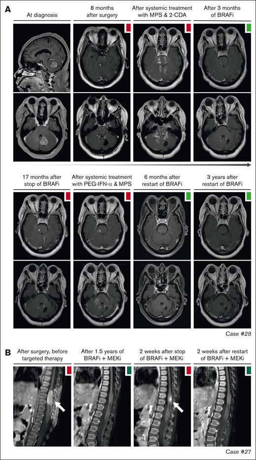 Disease progression after targeted therapy interruption. (A) Sagittal and axial MRI images of case 28, with CNS-AXG showing response of brain lesions to conventional therapies and targeted treatment with vemurafenib. After an initial PR to vemurafenib, targeted treatment was interrupted because of discontinued insurance coverage. Hereafter, brain lesions slowly progressed. Vemurafenib was restarted 3.6 years after interruption and quickly resulted in a decrease of brain lesions, with almost no lesions discernible at last follow-up. (B) Sagittal MRI images of case 27, with CNS-JXG showing relapse of a contrast-enhanced intramedullary spinal cord tumor after targeted therapy interruption. In this young child, treatment with dabrafenib and trametinib was interrupted after 1.6 years of therapy, while in complete radiologic remission. As an exit strategy, trametinib was stopped first, followed by dabrafenib 2 weeks later. MRI after stop of trametinib revealed persistent radiologic CR. However, MRI 2 weeks after stop of dabrafenib revealed recurrence of contrast-enhancement, consistent with a relapse of disease. MRI 2 weeks after restart of dabrafenib and trametinib showed that the radiologic response was recaptured. JXG, juvenile XG; MPS, methylprednisolone.