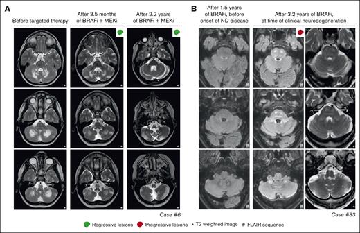 Response and progression of ND lesions. (A) Axial MRI images of case 6, with isolated ND-LCH showing significant reduction in T2-hyperintense lesions after treatment with dabrafenib and trametinib. Note that the remaining hyperintense lesion in the right cerebellum at last follow-up (right column; middle image) is related to the biopsy that was taken from this anatomical site. (B) Axial MRI images of case 33 showing the development of T2- and FLAIR-hyperintense lesions in the pons and cerebellum while receiving treatment with vemurafenib. The patient also developed clinical symptoms of neurodegeneration and died 7.5 months after the MRI scan depicting ND lesions was made. ND, neurodegenerative; FLAIR, fluid-attenuated inversion recovery.