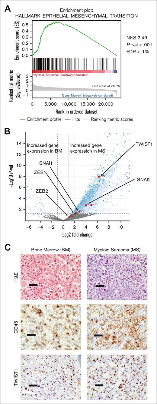 Transcriptomics of matched human samples identifies an EMT-like signature. (A) GSEA comparing MS and AML BM samples, with an EMT-like signature being the top hit based upon normalized enrichment score (NES). RNA was extracted from FFPE blocks. Significantly differentially expressed gene sets were identified as having a P value <.01 and FDR <5%. (B) Volcano plot indicating the expression of different transcription factors associated with EMT. Significantly differentially expressed genes were identified by a log2fold change of <1 or >1, and an Padj <.05. (C) Representative H&E and immunohistochemistry (IHC) for CD45 (white cell marker) and TWIST1. Black bars indicate 50 μm. All images derived from patient number 2 (supplemental Table 1). FDR, false discovery rate; GSEA, Gene Set Enrichment Analysis; H&E, hematoxylin and eosin.