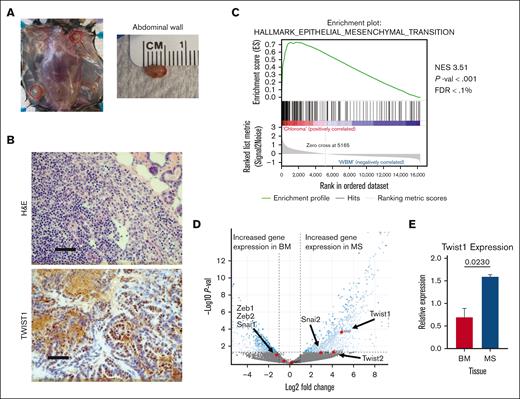A mouse model of Npm1cA AML that develops MSs reveals an EMT-like signature. (A) Example of an Npm1cA animal that has developed MSs. (B) Representative H&E and IHC for TWIST1. Black bars indicate 50 μm. (C) GSEA comparing MS and AML BM samples from mice, with an EMT-like signature being the top hit based upon NES. RNA was isolated from freshly collected tissue. Significantly differentially expressed gene sets were identified as having a P value <.01 and FDR <5%. (D) Volcano plot indicating the expression of TWIST1. Significantly differentially expressed genes were identified by a log2fold change of <1 or >1 and a Padj <.05. (E) RT-qPCR data for Twist1 expression in cKit+ cells from AML BM and MS, relative to the cKit– cells from each tissue. RT-qPCR, Reverse-Transcriptase Quantitiative PCR.