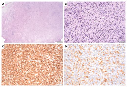 A biopsy of duodenum mass shows an effacement of duodenum architecture. (A) Hematoxylin and eosin stain, low power, (original magnification ×40), the infiltrates are composed of small- to medium-sized atypical lymphocytes. (B) Hematoxylin and eosin stain, high power, (original magnification ×200), diffusely positive for CD3, (C) Immunostain (original magnification ×200) and patchy CD30. (D) Immunostain (original magnification ×200).