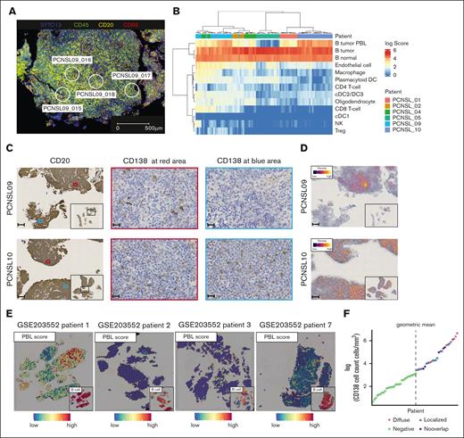 Spatial analyses of the heterogeneity of distribution of PBL signature positive cells. (A) Representative immunofluorescence image of GeoMx DSP shows the selected region of interests in PCNSL_09. Blue, nuclei stain (SYTO13); green, anti-CD45; yellow, anti-CD20; red, anti-CD68. Scale bar shows 500 μm. (B) Heat map of the estimated cell proportion in each area of interest (AOI) shows higher variation across samples than within samples. Each column represents an AOI. (C) Representative images of CD20 and CD138 IHC in 2 samples with PBL signature cells. In PCNSL_09, the distribution of CD138+ cells varies within the tumor, whereas in patient 10, CD138+ cells are uniformly distributed throughout the tumor. Small panel of CD20 staining shows an overall image of the tumor. Scale bar shows 200 μm (CD20) or 20 μm (CD138). (D) Representative density map of CD138 IHC in PCNSL_09 and PCNSL_10. Yellow lines represent CD138+ cells. Scale bar shows 200 μm. (E) Spatial feature plot shows the PBL signature score and B cells in publicly available data (Heming et al8). Patient 1 harbors PBL signature lymphoma cells and their distribution varies within the tumor, whereas other patients hardly harbor high PBL score areas. (F) Dot plot shows the logarithmic number of CD138+ cells per square millimeter in each sample. The dotted line denotes the determined cutoff value, derived as the geometric mean of CD138+ cell counts per square millimeter. The term "Diffuse" designates a uniform distribution of CD138+ cells throughout the tumor (the presence of CD138+ cells in more than two-thirds of the CD20+ area). "Localized" indicates a variable distribution of CD138+ cells within the tumor (the presence of CD138+ cells in less than two-thirds of the regions). “Negative” denotes instances where the count of CD138+ cells falls below the established cutoff value. “No overlap” indicates CD138+ cells are present outside the CD20+ regions. PBL, plasmablast; DC, dendric cell; NK, natural killer cell; Treg, regulatory T cell.