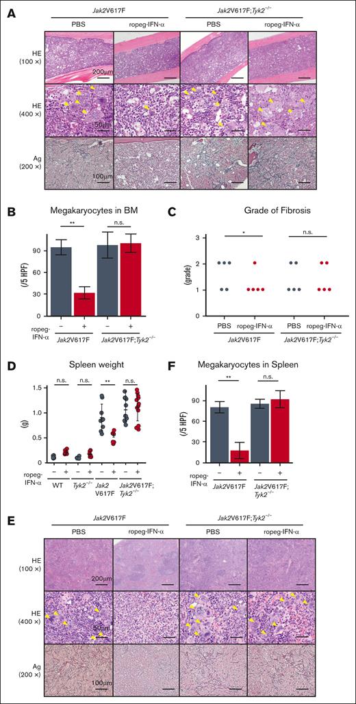 Effect of IFN-α on histological features of the BM and spleen in Jak2V617F and Jak2V617F;Tyk2−/− mice. (A) The representative histological change in the BM after 8 weeks of 600 ng of ropeg-IFN-α treatment. Top, HE staining (100×); middle, HE staining (400×); bottom, silver (Ag) staining (200×). A yellow arrowhead indicates a megakaryocyte. (B) Megakaryocyte numbers in the BM after treatment with ropeg-IFN-α, assessed across 5 high-power fields (HPFs) per slide. Jak2V617F mice (n = 5 per each treatment group); Jak2V617F;Tyk2−/− mice (n = 5 per each treatment group). Data are presented as mean ± SD. Statistical significance was determined by the Tukey test after 1-way ANOVA. ∗∗P < .01. (C) Semiquantitative BM fibrosis grading (grades 0-3) after treatment with ropeg-IFN-α (n = 5 for each treatment group per each genotype). Statistical significance was determined by the Mann-Whitney U test for 2 groups; ∗P < .05. (D) Spleen weight after 8 weeks of treatment with ropeg-IFN-α. WT mice (n = 6 per PBS and n = 7 per ropeg-IFN-α treatment); Tyk2−/− mice (n = 6 per PBS and n = 6 per ropeg-IFN-α treatment); Jak2V617F mice (n = 9 per PBS and n = 7 per ropeg-IFN-α treatment); Jak2V617F;Tyk2−/− mice (n = 11 per PBS and n = 12 per ropeg-IFN-α treatment). Data are presented as mean ± SD. Statistical significance was determined by the Tukey test after 1-way ANOVA; ∗∗P < .01. (E) Histological changes in the spleen after treatment with ropeg-IFN-α. Top, HE staining (100×); middle, HE staining (400×); bottom, Ag staining (200×). A yellow arrowhead indicates a megakaryocyte. In Jak2V617F mice treated with PBS, myeloid lineage cells, including megakaryocytes, had invaded and destroyed normal splenic architecture, and fibrosis was evident. A ropeg-IFN-α treatment resolved fibrosis and restored the normal splenic architecture in these mice. Conversely, in Jak2V617F;Tyk2−/− mice, despite ropeg-IFN-α treatment, myeloid lineage cell invasion and fibrosis did not improve. (F) Megakaryocyte numbers in the spleen, assessed across 5 HPFs per slide. Jak2V617F mice (n = 5 per each treatment group); Jak2V617F;Tyk2−/− mice (n = 5 per each treatment group). Data are presented as mean ± SD. Statistical significance was determined by the Tukey test after 1-way ANOVA; ∗∗P < .01. HE, hematoxylin and eosin; n.s., not significant.