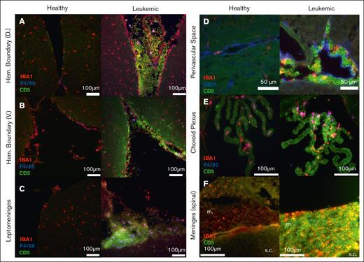LMO2 T-ALL cells are present at multiple sites throughout the murine CNS and are colocalized with tumor-associated myeloid cells. (A-F) Representative immunofluorescent (IF) images of transplanted LMO2 T-ALL cells (CD5+; green) interspersed with myeloid subsets (IBA1+, red; F4/80+, blue) in multiple locations within the CNS of leukemic mice, with comparable regions of healthy control mice shown adjacent. Cryosections of brain and spinal tissue indicate the presence of T-ALL and myeloid cells in the dorsal hemisphere boundary (original magnification ×20) (A), the ventral hemisphere boundary (original magnification ×20) (B), the leptomeningeal spaces (original magnification ×20) (C), the perivascular spaces with CD31 (blue) demarcating vasculature (original magnification ×40) (D), the choroid plexus within the third ventricle (original magnification ×40) (E), and the meningeal layer (m.) surrounding the spinal cord (s.c.; original magnification ×40) (F). In panels A-F, scale bars represent 100 μm, unless otherwise indicated.