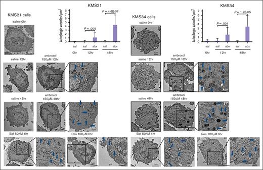 TEM observation of myeloma cells treated with Abx KMS21 and KMS34 cultured with 150 μM Abx for the indicated durations (0, 12, or 48 hours). Microstructural changes in Abx-treated cells were observed by TEM. Blue arrows indicate autophagic vacuoles including autophagosomes and autolysosomes. The autophagic vacuoles per micrometer squared of 20 randomly chosen cells were counted using TEM Center software (JEOL) and are illustrated in the bar graph. Statistical significance was evaluated by Student t test. Sal, saline; Abx, ambroxol; Res, resveratrol; Baf, bafilomycin A1.