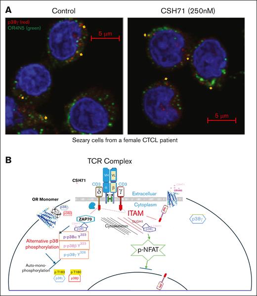 p38γ gains proximity to OR4N5 in the CD3 of the TCR complex in CTCL Sézary cells. (A) Sézary cells from a patient with CTCL were treated with CSH71 (250 nM, right) or untreated (control, left), followed by confocal immunofluorescence analysis. OR4N5 (red) and CD3E (green) colocalize, indicated by the merged yellow signal, suggesting an interaction between p38γ and OR4N5. (B) A summary of the involvement of these molecules in the signal transduction process of SS cells (malignant T cells). A cartoon diagram illustrates the proposed molecular mechanism by which p38γ may interfere with OR dimerization via protein-protein interactions within the TCR complex via alternative p38 activation. DLGH1, also known as DLG1, Discs Large MAGUK scaffold protein 1 (Human); ITAM, Immunoreceptor Tyrosine-based Activation Motif; p-NFAT, phosphorylated nuclear factor of activated T cells.