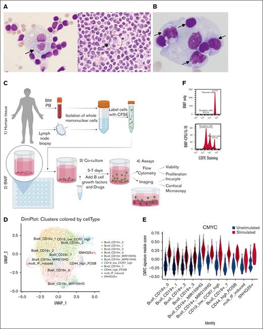 CIC in archived human lymphoma samples and TME models. (A) Pleural fluid (left) and lymph node biopsy (right) from a patient with lymphoplasmacytic lymphoma. Note the membrane of the outer cell in the LN biopsy (hard to see but discernable). Arrows highlight the CIC. (B) Pleural fluid from a patient with CLL. (C) Major steps in setting up TME models: (1-2) place collected human tissues with preseeded BMF; (3) add B-cell growth factors such as CpG/IL15 and drugs, coculture for 5 to 7 days or longer; and (4) perform assays with microscopy or flow cytometry. (D) UMAP of single cell genomics showing 11 cell clusters. (E) CLL cells under TME stimuli (CpG/IL-15) display increased MYC signature. (F) Cells divide into daughter cells; BMF only (Top); BMF+CpG/IL-15 (bottom). CFSE, Carboxyfluorescein Succinimidyl Ester; PB, peripheral blood; BM, bone marrow; UMAP, Uniform Manifold Approximation and Projection.