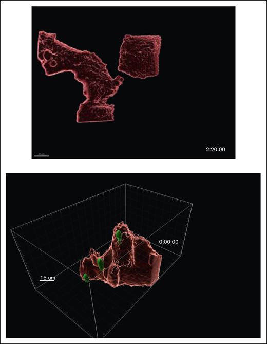 CLL cells were internalized by BMF and displayed active within-BMF movements. Time-lapsed microscopy showing the live dynamic process of CIC. Time-lapse live cell imaging was acquired on Leica SP8 TCS laser scanning confocal microscope equipped with an incubator for temperature, humidity and CO2 control. Two fields were captured with z-stack of 0.5 μm/slice and a total of 10 slices at original magnification ×20 magnification and 2 minutes interval for 17 hours. Two movies are included. Suggestion is to play movies slowly: click play then pause, then click along the progression bar, and follow 1 cell at a time through different movie frames.