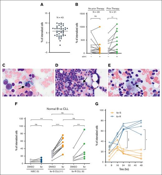 CIC is associated with prior therapies, increases with in vivo BTKi therapy and ex vivo ibr exposure. (A) Number of internalized cells were quantified for 43 CLL cases. Four to 6 fields were examined per sample. Each dot represents the average number of CIC per field per sample of 4 to 6 fields. Data are plotted on a log2 scale to accommodate the large variations from case to case. In one case, CIC was found in 1 of 6 fields examined, the average value is <1 and the log value is <0. (B) The number of internalized CLL cells in the presence or absence of TME stimuli, IL-15/CpG, and CD40L; 20 cases of untreated CLL (left); ns (P = .322); 21 cases of treated CLL (right); ∗∗P = .011 (analyzed by the Wilcoxson test). (C-E) CIC identified in the BM aspirates from patients on BTKi therapy (n = 3). (F) Upon ibr exposure, CIC is not changed in NBCs (n = 5), increased in sensitive CLL (Ibr-S; n = 11) and increased in resistant CLL (Ibr-R; n = 6). Cells were treated ex vivo with 0.4-μM ibr for 5 hours. Also see images in supplemental Figure 5. (G) Time course of CIC in both Ibr-S (orange; n = 5) and Ibr-R cells (blue; n = 5). Also see images in supplemental Figure 7. ∗P = .02; ∗∗∗P = .001. Ibr-R, ibr-resistant cases; Ibr-S, ibr-sensitive cases; ns, not significant.