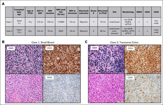 Characteristics and histology for the 2 patients who developed PTLD after rituximab. (A) Patient characteristics. (B) Histologic characteristics of case 1. (C) Histologic characteristics of case 2. DLBCL, diffuse large B-cell lymphoma; GCB, germinal center B cell; mPTLD, monomorphic PTLD; pPTLD, polymorphic PTLD.