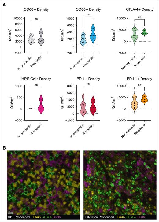 Multiplex immunofluorescence analysis of pretreatment tumor biopsies. CD86 and PD-L1 are typically expressed by PAX5-positive HRS cells and CD68+ macrophages, whereas CTLA-4 and PD-1 are most commonly expressed by CD3+ T cells. (A) The densities (cells per mm2) of CD68+ macrophages, PAX5(dim)-positive HRS cells, CD86+, PD-L1–positive, CTLA-4–positive, and PD-1–positive cells were not associated with a response to ipilimumab monotherapy. (B) Multiplex immunofluorescence staining of pretreatment biopsies from patient T01 (responder, left) and C07 (nonresponder, right) shows that, in both cases, a subset of the PAX5(dim)–positive HRS cells (yellow) coexpressed CD86 (purple) and are surrounded by and in contact with CTLA-4–positive cells (green). Similar expression and distribution of CTLA-4 in responders and nonresponders suggest that they limited efficacy of ipilimumab cannot be attributed to a lack of drug target in the TME.