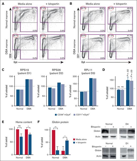 Bitopertin improves the erythroid cell maturation of marrow from patients with DBA. (A-B) Representative flow cytometry analysis of marrow mononuclear cells from a patient with DBA (D1) and a control subject (N1), cultured without or with 10 nM bitopertin after 10 days of culture. Lin– (lineage negative: CD3−, CD11b−, CD19−) cells from each culture were plotted as CD36 × GlyA (A) or CD71 × GlyA (B), showing the percentage of lin− cells in each quadrant. The largest improvement in the DBA marrow cultures is seen in the earliest precursors (CD36 or CD71 single positive), which are circled. (C-D) A total of 200 000 marrow mononuclear cells from control subjects or patients with DBA with mutations in RPS19, RPS26, or RPL11 were cultured for 7 to 13 days without or with bitopertin. The total number of erythroid cells in each culture was calculated from the number of cells in the highlighted quadrants using either CD36 × GlyA or CD71 × GlyA (see panels A-B). The day shown for each DBA sample is the day that each DBA sample showed peak improvement with bitopertin treatment, which was different for each patient’s marrow culture. Data are presented as the percentage of untreated which was calculated by dividing the numbers of erythroid cells recovered from the bitopertin treated cultures by the number of cells recovered from the untreated cultures individually for each control and patient culture (C) or as the mean ± standard error of the mean of all 4 patient and control cultures (D) at the day that each patient culture showed peak improvement. P values are shown for the comparison of the treated vs untreated (100%). (E) Relative heme content of bone marrow cultures from control subjects or patients with DBA after 7 days of culture without or with bitopertin. Samples were collected and analyzed for total heme content as before.4,11 Data are presented as the mean ± standard error of the mean (of 3 independent experiments) of the treated samples relative to the heme content of the untreated samples. (F) Relative amounts of globin protein in marrow cultures from control subjects or patients with DBA after 7 days of culture without or with bitopertin (left). Total protein was isolated from samples and analyzed via western blot (right) as before.4 Fluorescent images of the blots were captured on a Bio-Rad ChemiDoc MP and processed in Image Lab. Data are presented as a percentage of globin present in the untreated control sample after correcting for loading using actin (n = 2 independent experiments). ∗P < .05; ∗∗P < .01; ns, P > .05. ns, not significant.
