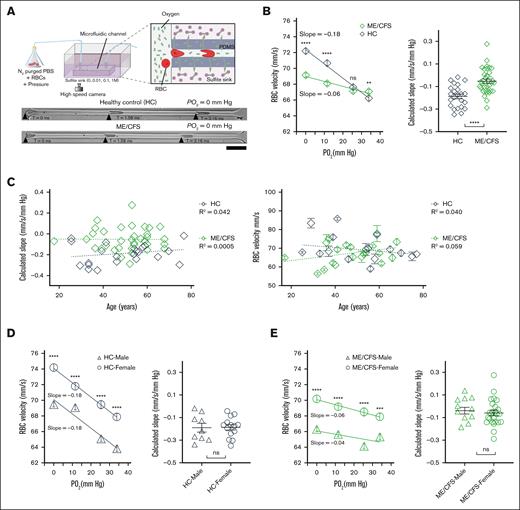 RBCs from ME/CFS exhibited reduced capillary velocity and sensitivity to reduced PO2. (A) Schematic of the microfluidic setup to measure ex vivo RBC capillary velocity at varied PO2 levels (top). Representative time-lapse images of RBCs from HCs and patients with ME/CFS flowing through a microfluidic capillary at PO2 of 0 mm Hg (bottom; scale bar, 25 μm). (B) The magnitude of capillary velocity and calculated velocity slope (ie, sensitivity) of RBCs from ME/CFS are significantly reduced compared to HCs (HCs, R2 = 0.99; n = 23 participants; 2556 cells; ME/CFS, R2 = 0.92; n = 35 patients; 3847 cells). ns, P > .05; ∗∗P < .01; ∗∗∗P < .001; ∗∗∗∗P < .0001 (Mann-Whitney test). Unpaired t test was used for slope comparison. Each data point in the calculated slope represents the slope from 1 participant. (C) Calculated slope and average RBC velocity (average of 4 PO2) showed no significant dependence on participant age (HCs, n = 23; ME/CFS, n = 35). Each data point represents 1 participant. (D-E) RBC capillary velocity but not the calculated slope (ie, sensitivity) was significantly different between sexes for HCs (D) and ME/CFS (E). Nine healthy male (R2 = 0.93) and 14 healthy female participants (R2 = 1.00) and 10 male (R2 = 0.48) and 25 female (R2 = 0.93) patients with ME/CFS were included. Each data point in the calculated slope represents 1 participant. Data are presented as mean ± standard error of the mean (SEM).