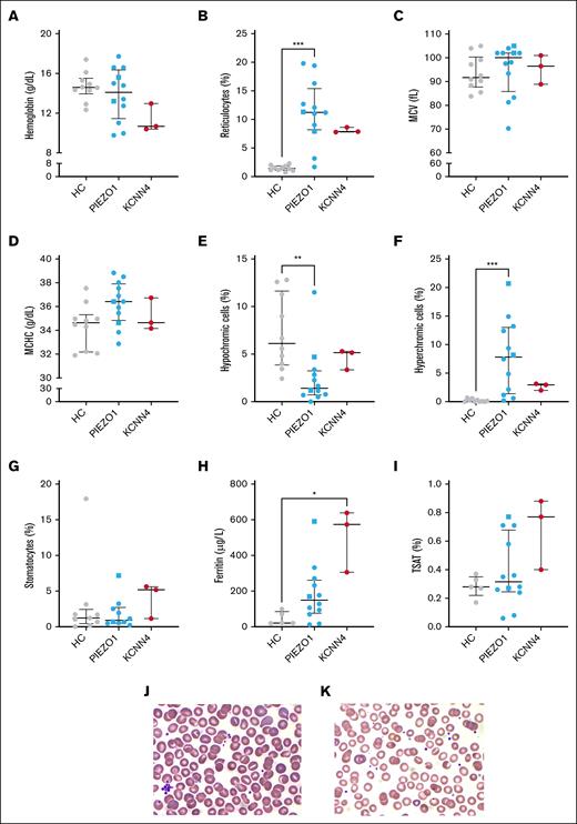 Routine hematologic parameters, ferritin levels, and stomatocyte counts of patients with HX with a PIEZO1 or KCNN4 mutation. (A-D) Various routine hematologic parameters were measured in HCs and patients with PIEZO1- and KCNN4-HX, including hemoglobin level (A), reticulocyte count (B), MCV (C), and MCHC (D). (E-F) Considering that dehydration is characteristic of HX, hypochromic cells (E) and hyperchromic cells (F) were measured. (G) The percentage of stomatocytes (PIEZO1, n = 10) was evaluated. (H-I) In addition, ferritin levels (H) and TSAT percentages (I) were compared between groups (HCs, n = 5). (J-K) Representative peripheral blood smears from PIEZO1-HX whole blood (J) and KCNN4-HX whole blood (K) are shown. Error bars represent median with IQR. ∗∗∗P < .001; ∗∗P < .01; ∗P < .05. Square symbols indicate splenectomized patients. MCV, mean corpuscular volume; TSAT, transferrin saturation.
