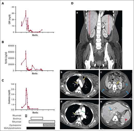 Inflammatory markers, impaired renal function, and imaging studies in iMCD-TAFRO. Plasma levels of (A) CRP (reference, <0.5 mg/dL), (B) ferritin (reference, 13-150 ng/mL), and (C) creatinine (reference, 0.5-1.2 mg/dL) are associated with a flare. Timeline for the administration of medications (rituximab, sirolimus, siltuximab, cyclosporine, and methylprednisolone) is indicated. (D) Coronal CT image showing (a) hepatosplenomegaly (red double arrow). Other panels (b-e) are axial images of the chest, abdomen, and pelvis. (b) Multiple enlarged mediastinal lymph nodes (yellow arrows). (c) Volume overload with diffuse anasarca and moderate volume ascites (blue arrows) with enlarged para-aortic lymph node (yellow arrow). (d) Mild dilatation of the main pulmonary artery (green double arrow), and adenopathy (yellow arrows). (e) Periportal edema (blue arrow) and wedge-shaped hypodensity in the posterior aspect of the spleen, concerning for small infarcts (red arrowhead).