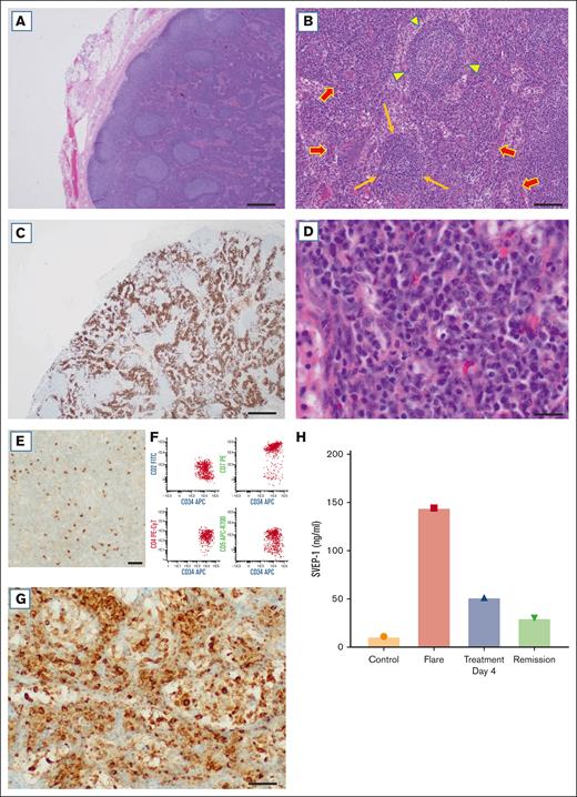 Histopathology, mTOR activation, and SVEP1 in iMCD-TAFRO. (A) Reactive follicular and paracortical hyperplasia (original magnification, ×20); scale bar, 500 μm. (B) Concentric mantle zones (arrowhead), regressed follicle (long arrows), and increased vascularity (arrows; original magnification, ×100); scale bar, 100 μm. (C) Areas with abundant plasma cells are positive for CD138 (original magnification, ×20); scale bar, 500 μm. (D) Plasma cells have mature morphologic features (original magnification, ×400); scale bar, 30 μm. (E) Scattered cells are positive for TdT (original magnification, ×400); scale bar, 30 μm. (F) Flow cytometry shows a population of T lymphoblasts positive for CD34 and CD7 (bright) and dim-to-negative CD2, CD4, and CD5. (G) Expression of pS6, a marker of mTOR activation, in areas with abundant plasma cells (original magnification, ×400); scale bar, 30 μm. (H) ELISA for SVEP1 shows results for controls (Controls), flare (Flare), 4 days after treatment (Treatment Day 4), and during remission (Remission) 6 months later. The biopsy was obtained during a flare.