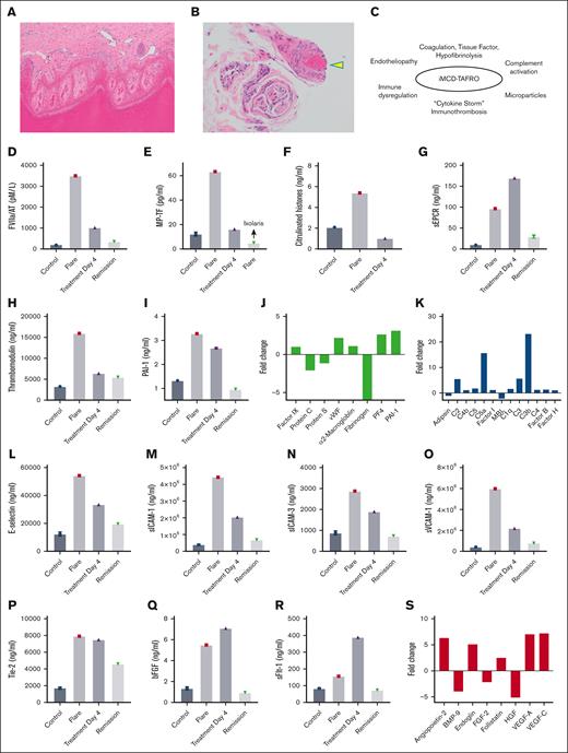 Thrombotic vasculopathy, immunothrombosis, and endotheliopathy in iMCD-TAFRO. (A) Acral skin with full thickness epidermal necrosis (original magnification, ×100). (B) Small vessels in the dermis and subcutaneous fat show thrombi (arrowhead; original magnification, ×200). (C) iMCD-TAFRO, inflammation, and immunothrombosis. (D) ELISA for FVIIa/AT, FVIIa/antithrombin complex. (E) MP-TF functional assay (TF activity was blocked by the inhibitor Ixolaris22). ELISA for citrullinated histones, a marker for neutrophil extracellular traps (NETs) (F), soluble endothelial protein C receptor (sEPCR) (G), thrombomodulin (H), and PAI-1 (I). Array 2 shows the fold change in coagulation factors (J) and components of the complement cascade (K). Array 1 shows plasma levels for E-selectin (L), sICAM-1 (M), sICAM-3 (N), sVCAM-1 (O), Tie-2 (P), bFGF (Q), and sFlt1 (R). (S) Array 2 shows the fold change in markers associated with endothelial cell activation and angiogenesis. Array 1 and ELISA results are for controls (Controls), flare (Flare), 4 days after treatment (Treatment Day 4), and in remission (Remission) 6 months later. Array 2 results are expressed as fold change during the flare vs remission.