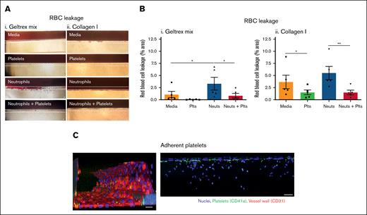 Platelets prevent RBC leakage in inflamed vessels. (A) RBC leakage requires neutrophil transmigration in Geltrex mix vessels. Vessels were cultured against Geltrex mix (i) or collagen I (ii) for 1 week, and then stimulated overnight with 10 ng/mL TNF-α + 10 ng/mL IL-1β. Plts and neuts were isolated from human blood and resuspended in EGM-FCS. They were then perfused through the vessels for 1.5 hours. RBCs were added to the vessels for 30 minutes and then RBC leakage was imaged using an iPhone through a bright-field microscope. Dashed lines highlight the phase guides, the top of which marks the vessel wall. (B) Platelets prevent RBC leakage from Geltrex mix and collagen I vessels. RBC leakage was quantified in FIJI. (C) Single platelets adhere to inflamed vessels. Vessels were fixed, blocked, and stained with Hoechst-33342 (blue), α-CD41a (green), and α-CD31 (red). Z-stacks were taken on a Leica SP5 confocal microscope. N = 5 independent experiments per blood donor, n = 2 chips per condition. Mean ± SEM; ∗P < .05 and ∗∗P < .01. Scale bars are representative of 50 μm.