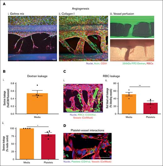Platelets preserve integrity of angiogenic vessels. (A) Perfusable angiogenic vessels can be induced into collagen I ECM. Vessels were cultured against Geltrex mix (i) or collagen I (ii) for 2 days in a 3-lane OrganoPlate before addition of an angiogenesis-inducing cocktail of vascular endothelial growth factor (VEGF), S1P, basic fibroblast growth factor (bFGF), and PMA to the bottom channel for 8 days. Vessels were fixed, blocked, and stained with Hoechst-33342 (blue), phalloidin-FITC (green), and α-CD31 (red). Z-stacks were taken on a Leica SP5 confocal microscope. (iii) After 8 days of angiogenesis induction, collagen I vessels were perfused with 250 kDa FITC-dextran (green) or RBCs for 45 minutes and imaged on an EVOS M5000/bright-field microscope. (B) Platelets reduce angiogenic vessel permeability. Platelets were isolated from human blood and resuspended in EGM-FCS. They were then perfused through the vessels for 1.5 hours 250 kDa FITC-dextran was added to the vessels for the last 45 minutes of platelet perfusion, and then fluorescence imaged on an EVOS M5000. Dextran leakage was calculated by dividing the fluorescence in the ECM by the fluorescence in the vessel. Data were then normalized to the media only control. (C) Platelets prevent RBC leakage from angiogenic vessels. (i) Vessels were prestained with CellMask Deep Red Plasma Membrane stain (red). After the process described in panel B, RBCs were added to the vessels for 30 minutes. Vessels were then fixed, blocked, and stained with Hoechst-33342 (blue), and α-CD235a (green). Z-stacks were taken on a Leica SP5 confocal microscope. (ii) RBC leakage was quantified in FIJI. (D) Platelets bind singly to angiogenic vessels. Vessels (red) were fixed, blocked, and stained with Hoechst-33342 (blue), and α-CD41a (green). Z-stacks were taken on a Leica SP5 confocal microscope. 3D reconstructions were generated in FIJI. N = 4 independent experiments per blood donor, n = 3 chips per condition. Mean ± SEM; ∗P < .05 and ∗∗P < .01. Scale bars are representative of 50 μm.