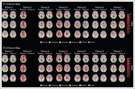 z score maps for myelin water imaging of patients with CM-TMA vs controls. In T1 and T2 z score maps, red regions indicate significant increases (z score of less than −3.1). Regions used in myelin water imaging are overlaid and color-coded.