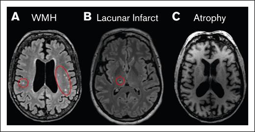 Representative image of radiologic findings. (A) T₂-FLAIR image of multiple WMHs (red circles). (B) T₂-FLAIR image of a chronic lacunar infarct (red circle). (C) MPRAGE image showing whole-brain volume loss (atrophy). MPRAGE, magnetization-prepared rapid acquisition with gradient echo; WMH, white matter hyperintensities.