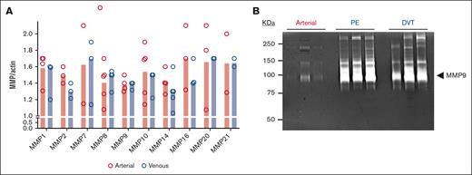 MMPs in thrombus from patients with thrombotic stroke and VTE. (A) RNA extracted from 7 mg of thrombus was quantified using reverse transcriptase PCR (quantitative reverse transcription PCR) for MMPs. Where RNA was found in at least 3 thrombi from each group, the data are reported as the mean ± SEM. The absence of data points indicated that RNA in the thrombus (but not in the positive control) was not detected. (B) Protein extracted from 7 mg thrombus was isolated and analyzed for separation by SDS-polyacrylamide gel electrophoresis (SDS-PAGE) then activity assessed by in-gel zymography. MMP9 is the dominant isoform at 96 kDa seen most prominently in venous thrombi. A representative zymogram for n = 3 thrombi evaluated in each group is shown. Missing data points indicated that the gene was not present in the analyzed sample.