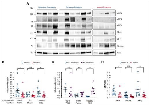 Circulating cellular markers in thrombus from patients with thrombotic stroke and VTE. (A) Protein extracted from 7 mg thrombus was isolated and separated by SDS-PAGE before immunoblotting using protein markers found on WBCs (CD45), platelets (CD41), and red blood cells (RBCs) (CD235a). Actin was used as a loading control. Immunoreactive bands were quantified by densitometry and reported as mean ± SEM. ∗P = .01 (MWU); ∗∗P = .02 (t test); ∗∗∗P = .040 (MWU). (B) Protein extracted from 7 mg thrombus was isolated and separated by SDS-PAGE and then assessed for standard cell surface markers used for identification of WBCs, RBCs, and platelets. Immunoreactive bands were quantified by densitometry and reported as mean ± SEM. ∗P = .01 (MWU); ∗∗P = .02 (t test). (C) Protein extracted from 7 mg thrombus was isolated and separated by SDS-PAGE and then assessed for standard cell surface markers used for identification of WBCs, RBCs, and platelets. Immunoreactive bands were quantified by densitometry and reported as mean ± SEM. ∗∗P = .04 (MWU). (D) Protein extracted from 7 mg thrombus was isolated and analyzed, separated by SDS-PAGE, and assessed for MMP1, MMP2, and MMP9 protein content. Actin was used as a loading control. Immunoreactive bands were quantified by densitometry and reported as mean ± SEM. ∗P = .0044 (MWU); ∗∗P = .0003 (MWU). NS, not significant.