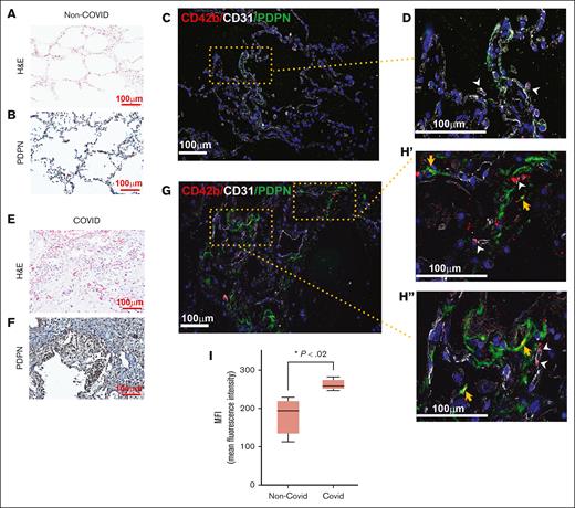 Expression of PDPN in the lung in COVID-19 pneumonia. Tissue specimens from the lungs of patients with COVID-19 pneumonia and patients without COVID-19 obtained during autopsy were examined. (A) Hematoxylin and eosin (H&E) and (B) immunohistochemistry stain for PDPN of the non–COVID-19 lung. Immunofluorescence staining of non–COVID-19 lungs with (C) lower original magnification (×100) and (D) higher original magnification (×200) showing few platelets in the lung parenchyma inside blood vessels (white arrowheads). (E) H&E and (F) immunohistochemistry stain for PDPN of COVID-19 lungs. Immunofluorescence staining of COVID-19 lungs at (G) lower original magnification (×100) and (H′-H′′) higher original magnification (×200). Platelets inside blood vessels are indicated with white arrowheads, and those colocalized with PDPN with yellow arrowheads. (I) Expressions of PDPN in COVID-19 and non–COVID-19 lungs are compared as mean fluorescence intensity (MFI) of immunofluorescence-stained slides. The box and whisker graph shows minimum to maximum values in each group (non–COVID-19: 182.5 ± 24.8, COVID-19: 261.7 ± 7.42; n = 4 images per group; P = .02, unpaired t test).