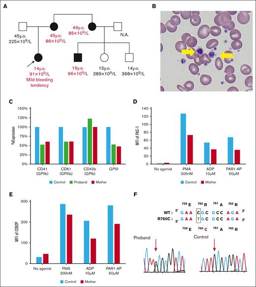 Analysis of a family with β3(R760C)-related macrothrombocytopenia. (A) Family tree of the proband. Squares represent the male and circles represent the female family members. Arrow indicates the proband. Clinical status is indicated by the open (unaffected) or solid (affected) symbol. Age and platelet count are listed under each symbol. (B) May-Grünwald Giemsa staining of the proband peripheral blood film. Giant platelets are indicated by yellow arrows. (C) Surface GP expression levels in platelets were determined via flow cytometry. Data are shown as percentage expression relative to the father’s platelets (healthy control). (D) PAC-1 binding on platelets with or without agonists was detected via flow cytometry. (E) P-selectin (CD62P) expression with or without agonists was determined via flow cytometry. Representative results of 2 to 3 independent experiments are shown in panels C-E. (F) Genetic analysis of the proband and her father (control). Sequencing of platelet complementary DNA and genomic DNA revealed that the affected family members exhibited the heterozygous β3(R760C) mutation. MFI, mean fluorescence intensity; N.A., not available; y.o., years old.
