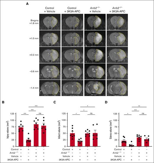 3K3A-APC protection against ischemic stroke in vivo requires β-arrestin 2. (A) Representative T2-weighted (structural) coronal MR scans showing postischemic injury area (hyperintense signal) in the ipsilateral cortex 24 hours after tMCAo in control and Arrb2–/– mice on C57BL/6J genetic background treated with vehicle or 3K3A-APC (0.8 mg/kg intraperitoneally 10 minutes and 4 hours after the start of tMCAo). Postischemic injury areas are delineated by yellow dashed lines. (B-D) Injury (B), infarct (C), and edema volumes (D) 24 hours after tMCAo in control and Arrb2–/– mice treated with vehicle or 3K3A-APC as above in panel A. Control + vehicle (n = 7); Control + 3K3A-APC (n = 6); Arrb2–/– + vehicle (n = 7); and Arrb2–/– + 3K3A-APC (n = 6). All volume measurements derived from structural T2-weighted MR images. Data in panels B-D are shown as dot plots representing single points per mouse. Each bar represents mean ± standard error of the mean. Statistical significance was determined by 1-way analyses of variance followed by Tukey multiple comparison test. ∗P < .05; ∗∗P < .01; ∗∗∗P < .001. ns, nonsignificant. The panels B-D in Figure 2 were modified to have the same y-axes, but the data are the same as originally submitted.