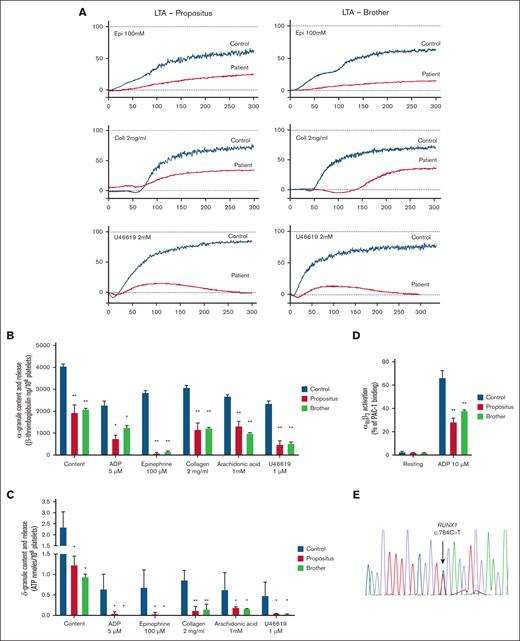 Platelet function testing and sequencing. (A) Human platelet aggregation in response to epinephrine (Epi; 100 μM), collagen (Coll; 2 mg/mL), U46619 (1 μM) in platelet-rich plasma from the patient (left panels), his brother (right panels), and parallel healthy controls. Traces are representative of 4 independent experiments. (B) α-granule secretion in platelets from the patient, his brother, and parallel healthy controls, as assessed by the measurement of β-thromboglobulin content and secretion by enzyme-linked immunosorbent assay. Agonists were adenosine 5′-diphosphate (ADP; 5 μM), Epi (100 μM), Coll (2 mg/mL), arachidonic acid (1mM), and U46619 (1 μM). β-thromboglobulin levels are reported as ng/108 platelets. Data are presented as means ± standard error of the mean (SEM) from 4 independent experiments. ∗P < .05 vs control; ∗∗P < .01 vs control; 2-way analysis of variance (ANOVA). (C) δ-granule secretion in platelets from the patient, his brother and parallel healthy controls as assessed by the measurement of adenosine triphosphate (ATP) content and secretion by lumiaggregometry. Agonists were ADP (5 μM), Epi (100 μM), Coll (2 mg/mL), arachidonic acid (1 mM), and U46619 (1 μM). ATP is reported as nanomoles per 108 platelets. Data are presented as means ± SEM from 4 independent experiments. ∗P < .05 vs control; ∗∗P < .01 vs control; 2-way ANOVA. (D) Integrin αIIbβ3 activation (PAC-1 binding) as assessed by flow cytometry in response to ADP (10 μM) in whole blood from the patient, his brother, and parallel healthy controls. PAC-1 binding is reported as percentage of positive platelets, calculated as the percentage of platelets (gated for their forward scatter and side scatter values, and for their positivity to the platelet marker CD42b) that bound PAC-1 over the total platelet population after setting of nonspecific binding. Data are presented as means ± SEM from 4 independent experiments. ∗∗P < .01 vs control; 2-way ANOVA. (E) Sequencing of DNA from the finger nails of patient brother, showing the heterozygous c.784C>T variant in RUNX1, leading to p.Gln262Ter.