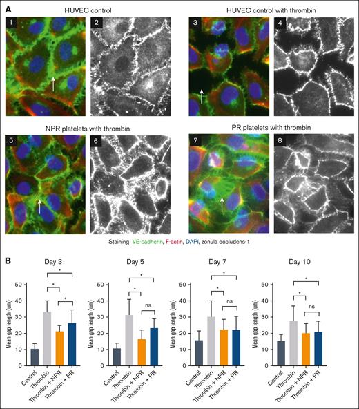 NPR and PR platelets attenuate thrombin-induced disruption of adherens and tight junctions. (A) Treatment with NPR or PR platelets lessened the loss of endothelial junctional proteins in response to thrombin challenge. HUVEC monolayers were stained for VE-cadherin (green), F-actin with phalloidin (red), and DAPI (4′,6-diamidino-2-phenylindole; blue) in images 1, 3, 5, and 7 as well as ZO-1 (white) in images 2, 4, 6, and 8. White arrows highlight gaps between endothelial cells. Platelets from trials 2 and 3 were tested on days 3, 5, 7, and 10, and representative images from trial 2, day 5 are shown. (B) Quantified gap measurement was significantly less in day 3 NPR platelets (orange) compared with PR platelets (blue), but that difference was not maintained as the platelets aged. In addition, there was an increase in gap size between cells with thrombin alone compared with control and a statistically significant decrease with both treatment of NPR and PR platelets. Differences were calculated with 2-way ANOVA. ∗P < .05. ns, nonsignificance.
