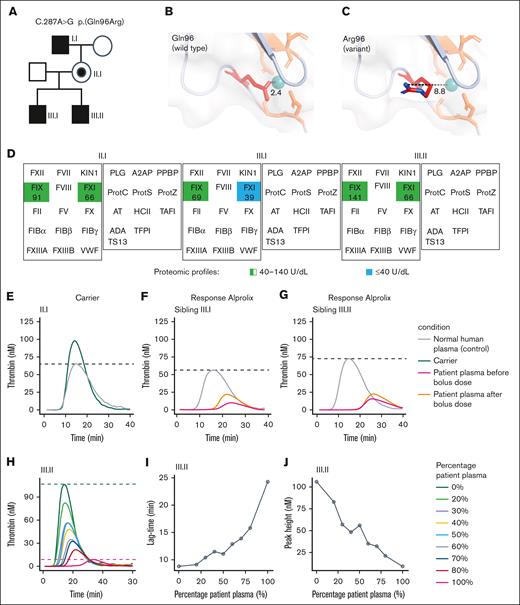 Hemophilia B caused by an F9 mutant, initially classified as variant of unknown significance, which results in a qualitative defect and impaired thrombin generation. (A) Pedigree with inherited F9 C.287A>G mutant resulting in p.(Gln96Arg) variant. (B-C) The p.(Gln96Arg) variant is located in the EGF-1 domain and introduces a positively charged arginine within the calcium ion binding cavity. (D) Other deficiencies or abnormalities in proteins contributing to the severe bleeding phenotype were excluded by quantitative mass spectrometry–based screening of plasma proteins corresponding to the tier 1 diagnostic gene list,25 updated and endorsed at the International Society of Thrombosis and Hemostasis 2023 conference. Normal concentration of coagulation and fibrinolysis proteins in the plasma was confirmed, except for mild FXI deficiency (39 U/dL) identified in 1 sibling (III.1). (E) Thrombin-generation profile with plasma from the carrier (II.I). (F-G) Thrombin generation with plasma from siblings (III.I) and (III.II) before and 1 hour after 25 U/kg Alprolix as prophylaxis. (H) Inhibitor testing by mixing normal plasma pool and patient plasma (III.II) followed by thrombin generation with (I) lag time and (J) peak height. Data were obtained by calibrated automated thrombography (CAT) assay with 1 pM TF for coagulation initiation. Dashed lines indicate the peak height in the control condition (pooled normal human plasma).