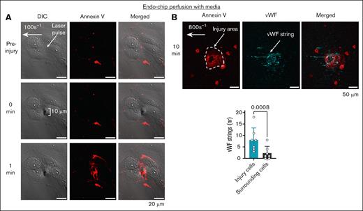 Laser injury of the perfused endothelial monolayer induces a procoagulant surface by PS exposure and secretion of VWF. (A) Laser pulse to the endothelial monolayer (arrow) perfused with media (at shear 100 s–1), induces an endothelial injury of ∼10 μm with subsequent PS exposure (measured by annexin V binding, red) within 1 minute, but does not disrupt endothelial junctions. Representative images. Scale bar, 20 μm. (B) Laser pulse to the endothelial monolayer (arrow) perfused with media under shear 800 s–1, leads to the secretion of VWF (cyan) from the injured endothelium (stained with annexin V, red). Scale bar, 50 μm. Number of strings counted on annexin V-positive cells (injury, cyan) vs surrounding annexin V-negative cells (gray). Mean ± standard deviation (SD), n = 7 injuries from n = 3 independent experiments, paired t test. DIC, differential interference contrast.