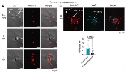 Laser injury of the perfused endothelial monolayer induces a procoagulant surface by PS exposure and secretion of VWF. (A) Laser pulse to the endothelial monolayer (arrow) perfused with media (at shear 100 s–1), induces an endothelial injury of ∼10 μm with subsequent PS exposure (measured by annexin V binding, red) within 1 minute, but does not disrupt endothelial junctions. Representative images. Scale bar, 20 μm. (B) Laser pulse to the endothelial monolayer (arrow) perfused with media under shear 800 s–1, leads to the secretion of VWF (cyan) from the injured endothelium (stained with annexin V, red). Scale bar, 50 μm. Number of strings counted on annexin V-positive cells (injury, cyan) vs surrounding annexin V-negative cells (gray). Mean ± standard deviation (SD), n = 7 injuries from n = 3 independent experiments, paired t test. DIC, differential interference contrast.