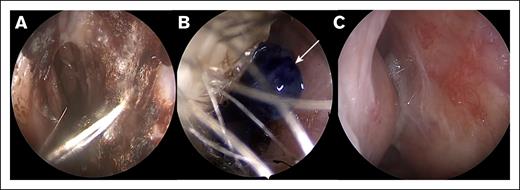 Nasal mucosa before and after RADA16 application. Right nasal cavity of patient with HHT revealing (A) crusting and inflammation associated with HHT-related epistaxis, (B) Application of RADA16 in its hydrogel form combined with methylene blue for visualization (arrow). (C) Follow-up examination revealing well-moisturized nasal mucosa without inflammation, crusting, or bleeding.