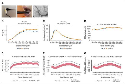 GlycoCheck parameters in HIs and patients, and correlation with EASIX. (A) Schematic representation of the GlycoCheck sublingual microscope, including the measurement setup, sublingual positioning, and an example image showing RBC flow through capillaries (see also supplemental Video). (B-D) Comparison of HIs and patients with hematological disease (preconditioning) across key GlycoCheck endothelial parameters stratified by VD between 4 and 25 μm. Median values were calculated for each individual and plotted by vessel size; (B) PBR (μm); (C) vascular density (mm/mm2); (D) RBC velocity (μm/s). P values from Wilcoxon rank-sum tests comparing HIs and patients are indicated for each diameter range. (E-F) Spearman ρ correlation coefficients (with 95% CIs) for EASIX and GlycoCheck parameters, calculated by individual VD. (E) Correlation between EASIX and PBR; (F) correlation between EASIX and vascular density; (G) correlation between EASIX and RBC velocity. VD, vessel diameter.
